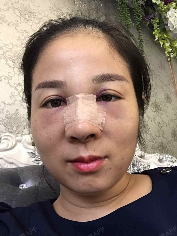 今天眼睛肿起来了,鼻子也肿,整个人肿得跟个猪头一样_圈子-新氧美容