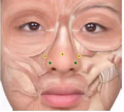 【科普贴亚洲人面部推荐注射方法】a型肉毒毒素注射实_圈子-新氧美容