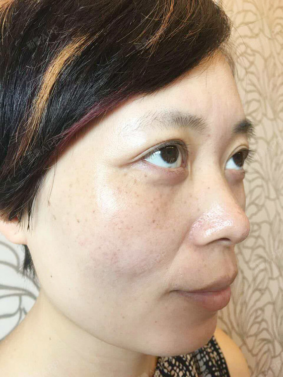 第一次做完脸上的斑没有感觉少了