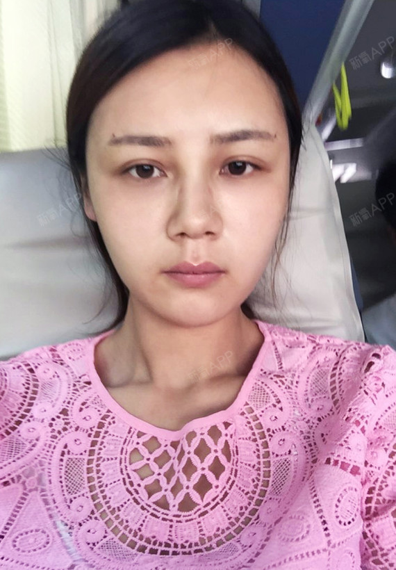 第五天,早时候是圆脸,跟着就行,打了瘦脸针打完以后看着脸的确瘦了