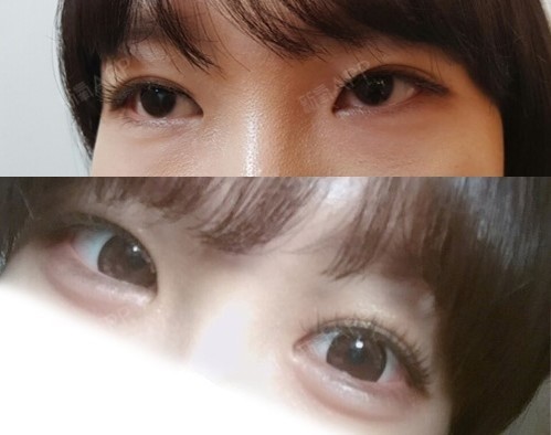 北京玻尿酸丰卧蚕好不好_效果图_卖女孩的小火柴i玻尿酸丰卧蚕术后第6