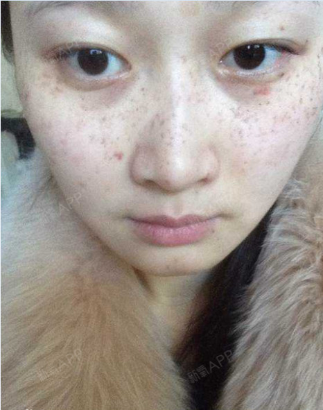 激光祛斑好不好_效果图_越冰丹激光祛斑术后第0天_新氧美容整形