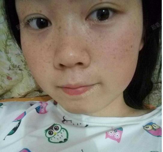 激光祛斑好不好_效果图_越冰丹激光祛斑术后第0天_新氧美容整形