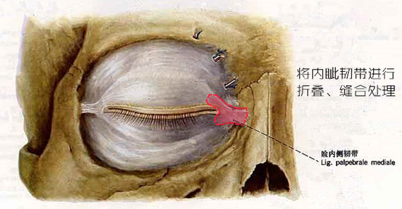 内眦韧带断裂图片