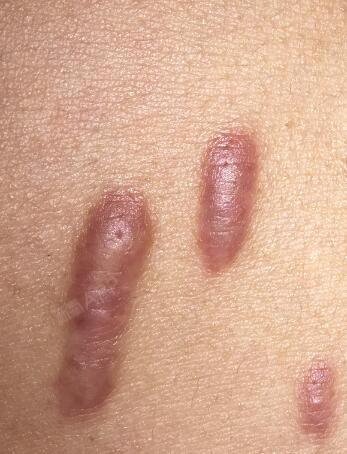 胸前留疤痕了,就长了几颗痘痘用手抠了抠,胸前就留下_圈子-新氧美容