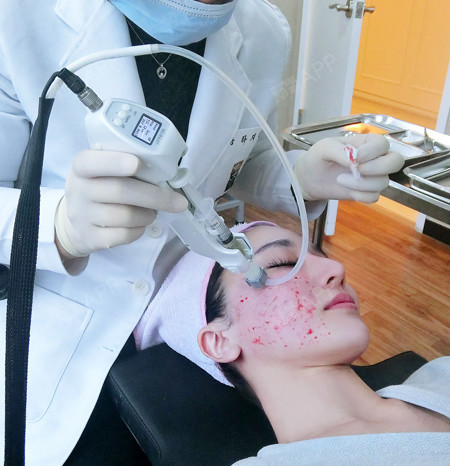 prp水光针真的非常上瘾,看到皮_圈子-新氧美容整形