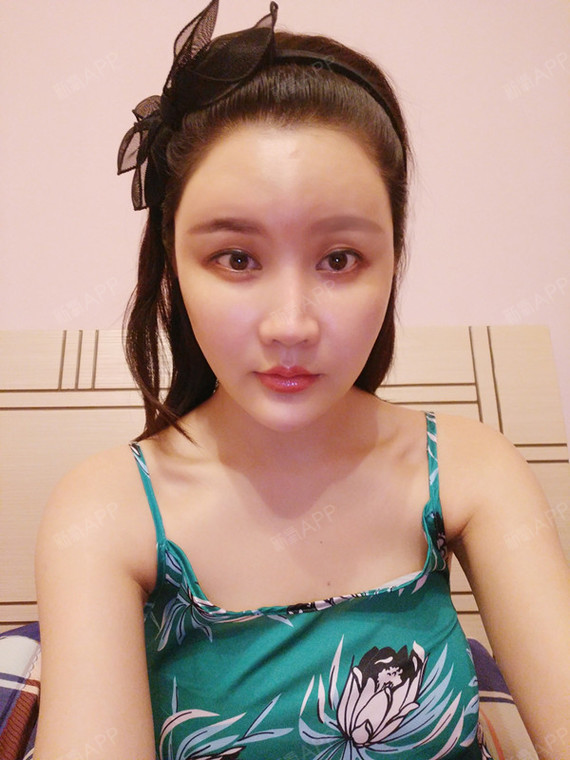 重庆埋线提升好不好_效果图_小凤姐埋线提升术后第3天_新氧美容整形