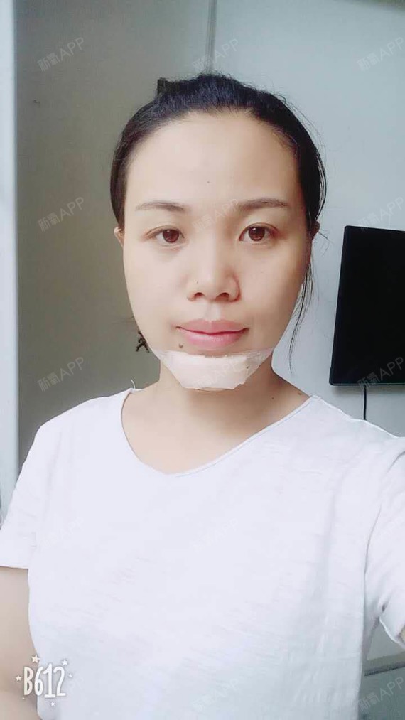 长沙鹏爱医疗美容医院假体下巴三天