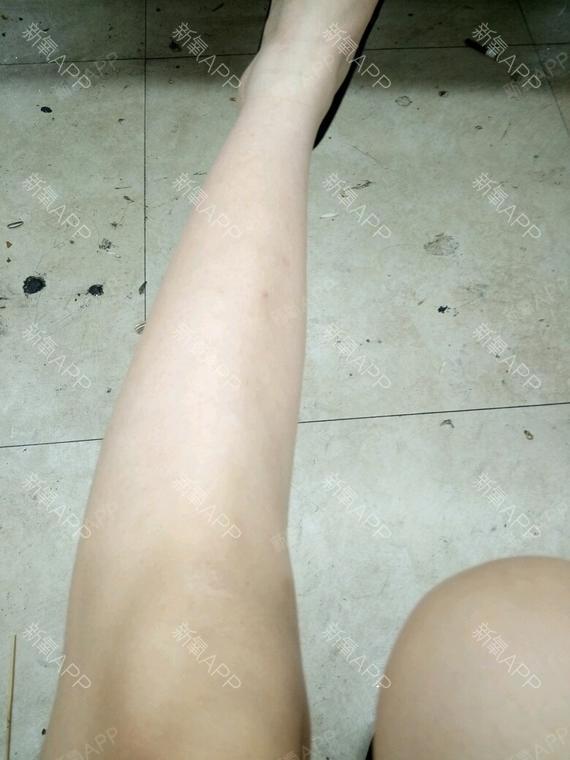 天津脱大小腿好不好_效果图_氧气ciqe8bc脱大小腿术后第5天_新氧美容