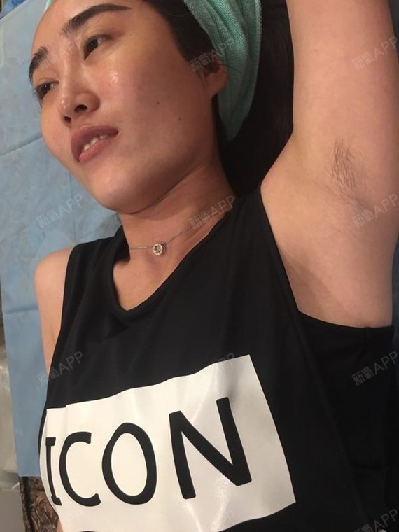新氧 你就是我滴天使 激光脱毛 术后当自强 合肥同城 脱腋毛