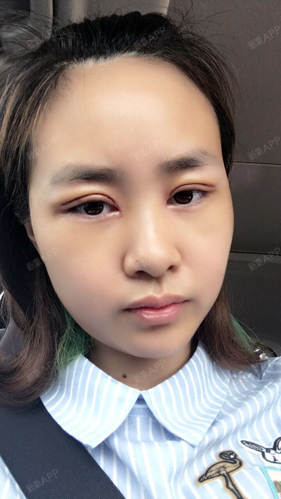切开双眼皮好不好_效果图_泡泡儿1切开双眼皮术后第9天_新氧美容整形