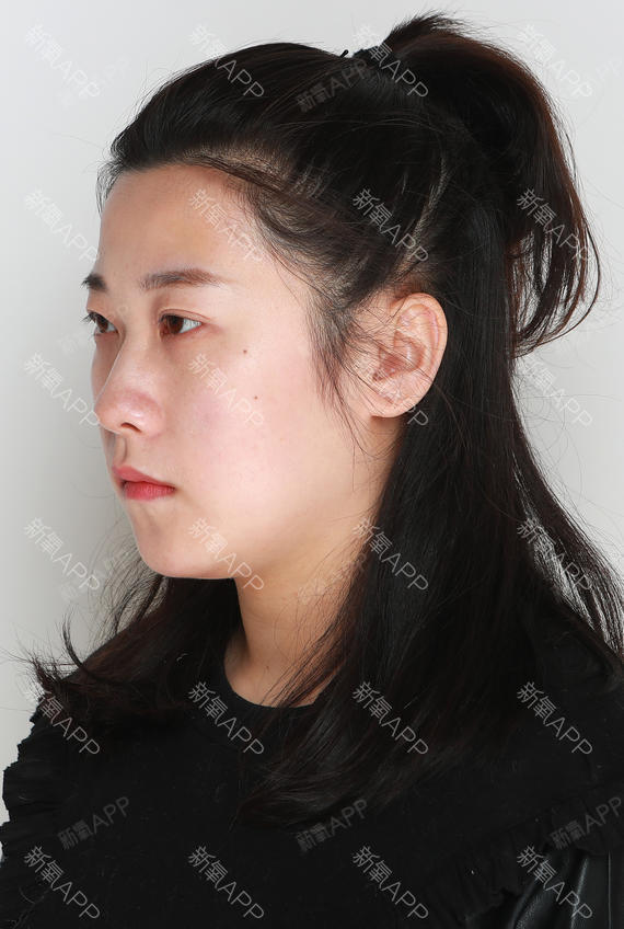 杭州玻尿酸隆鼻好不好_效果图_秋白芍玻尿酸隆鼻术后第0天_新氧美容