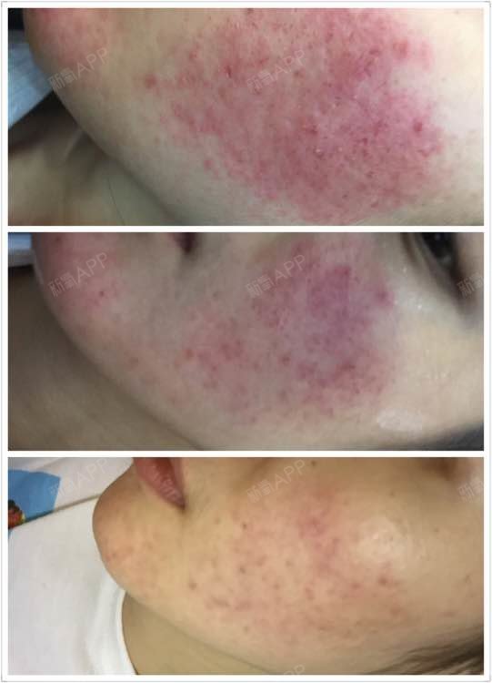 新氧- 史南静 | 术后当自强 | 成都同城 | 黄金微针