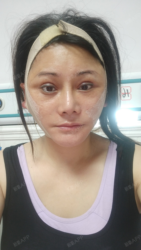 埋线提升