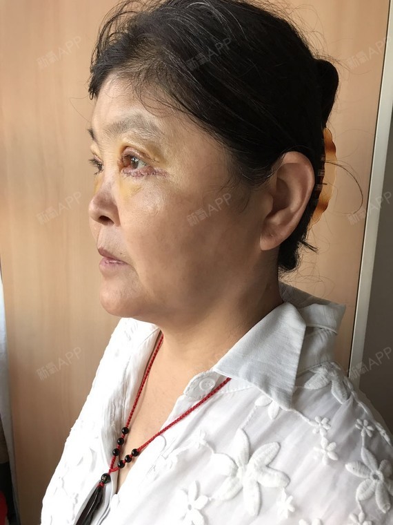 北京外切去眼袋好不好_效果图_铁匠营外切去眼袋术后第3天_新氧美容