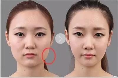 用双手感受咬肌凸起看是否又大又硬如果你属于这种情况打个瘦脸针get