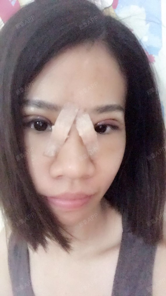 割完双眼皮后,眼睛一开始很肿,又不能乱吃东西,平时_圈子-新氧美容