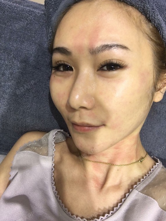 激光祛斑好不好_效果图_氧气wsg5979激光祛斑术后第2天_新氧美容整形