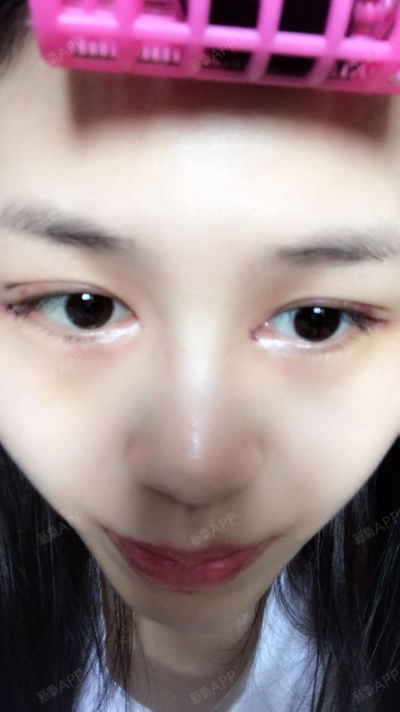 新氧- 猫汪 | 开外眼角 | 术后当自强 | 成都同城