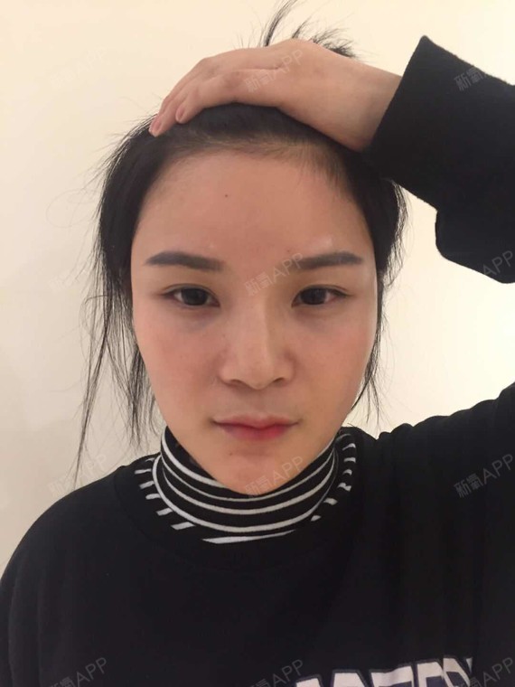 我的额头比较扁平没有立体感看着特不饱满特没有精神男朋友虽然嘴上说