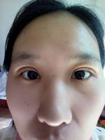 不知道不觉我拥有双眼皮大眼睛已经十一天了,过的真快