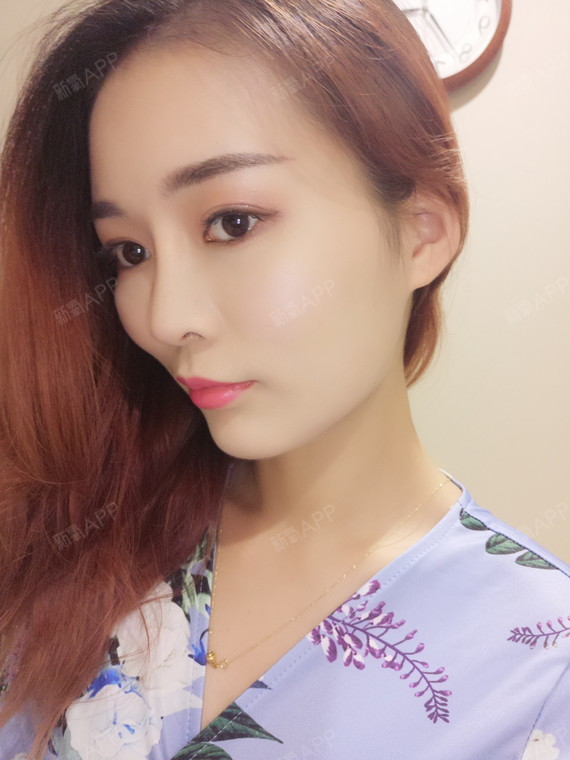 成都切开双眼皮好不好_效果图_冰姬肌i切开双眼皮术后第73天_新氧美容