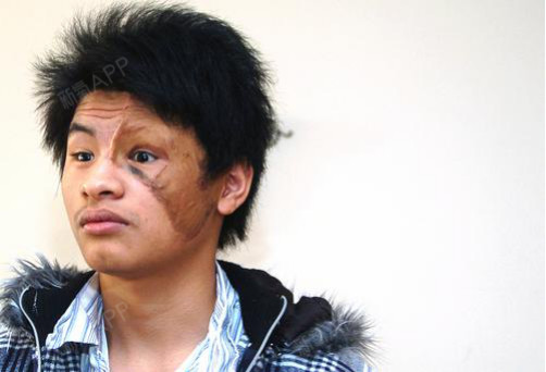 阴阳脸女孩上海求医医院巧遇"兽皮男"(图)