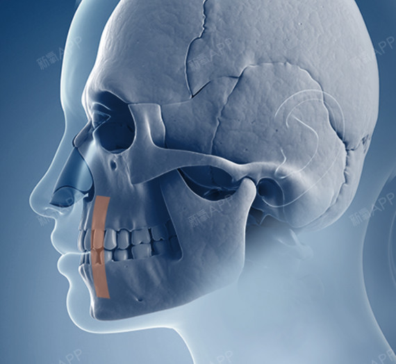 于将上颚及下颚整体移动的两颚手术不同,da突嘴手术是?