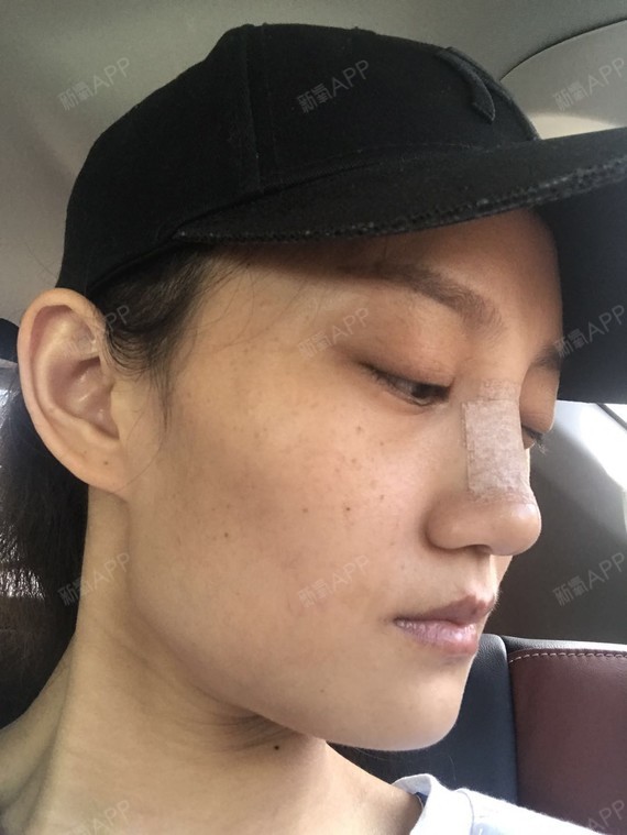 术前照:鼻根凹陷,鼻背过宽,显得鼻头不够挺翘._圈子-新氧美容整形
