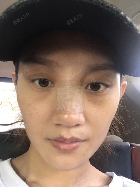 术前照:鼻根凹陷,鼻背过宽,显得鼻头不够挺翘._圈子-新氧美容整形
