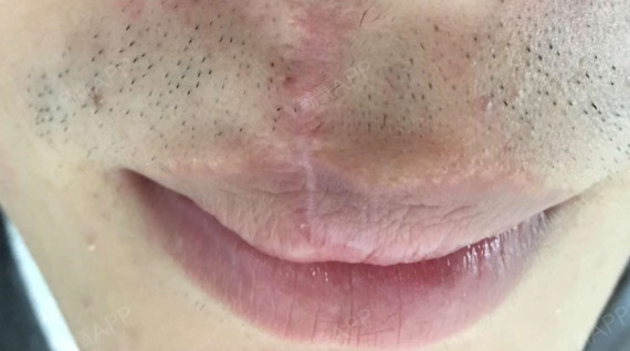 嘴唇上的凹陷疤痕怎么治疗呢?