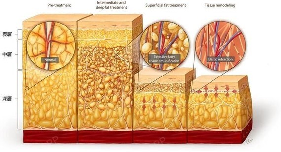 皮下脂肪通常分为三层:皮下固有脂肪层,浅层脂肪层,深层脂肪层