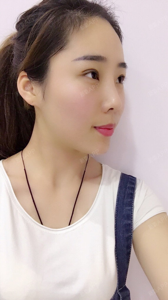 杭州好不好_效果图_炎炎夏日海边的风术后第天_新氧美容整形