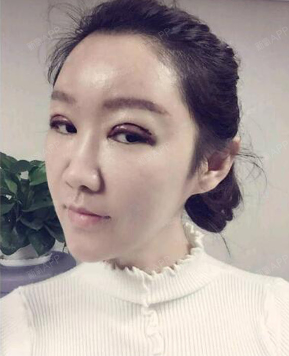 但不会很肿,没有别人说的那么夸张,闭眼能看见清晰的切口,双眼皮形状