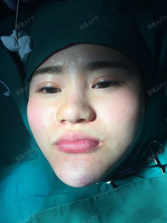我之前做的假体下巴也歪了,然后取出来了,还形成了瘢痕