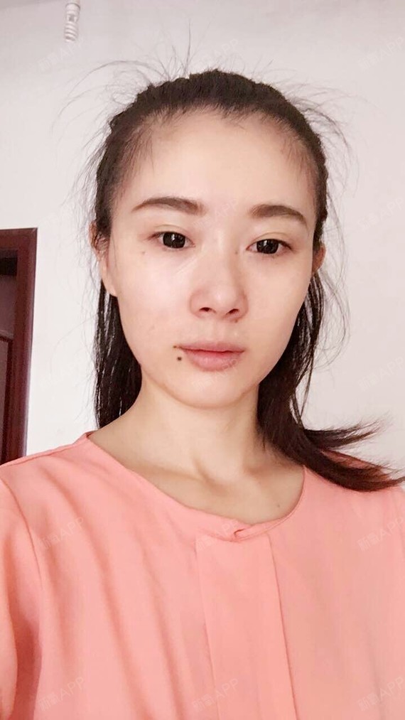 【格莱美 玻尿酸填充额头 术后7天】