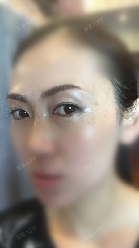 切眉术好不好_效果图_cora11切眉术术后第20天_新氧美容整形