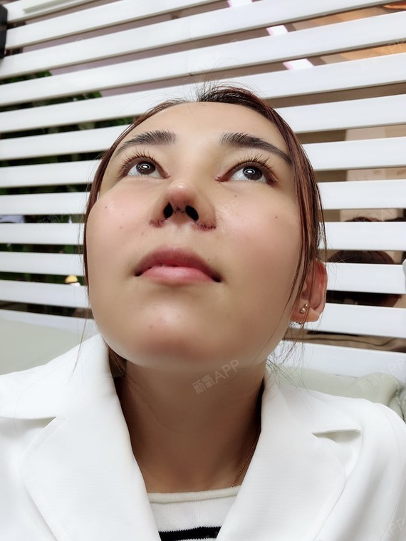 kawaii仙女膨体隆鼻第5天美丽日记