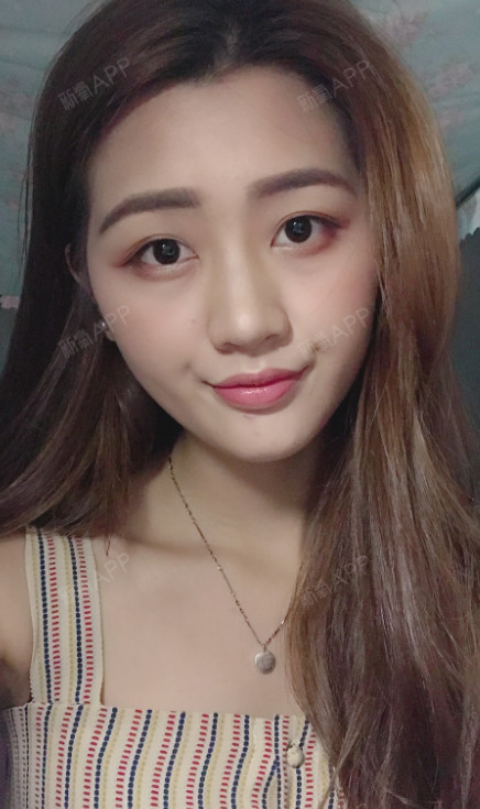 武汉自体脂肪全脸填充好不好_效果图_小小小谢自体脂肪全脸填充术后第