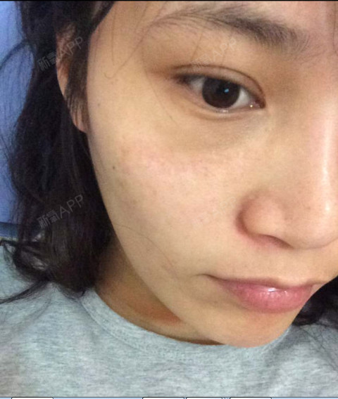 经过40天的回复期间,我脸上的疤痕已经明显淡化了很_圈子-新氧美容