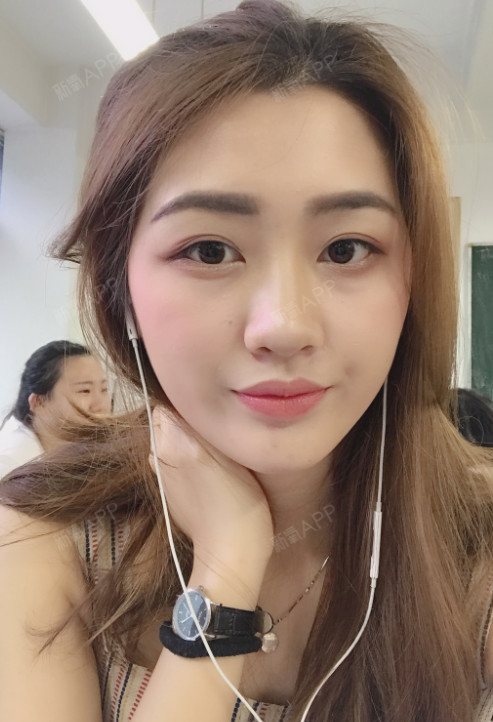武汉自体脂肪全脸填充好不好_效果图_小小小谢自体脂肪全脸填充术后第