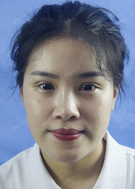 宝贝们好久不见[:6][:6],今天距离我割双眼皮_圈子-新氧美容整形