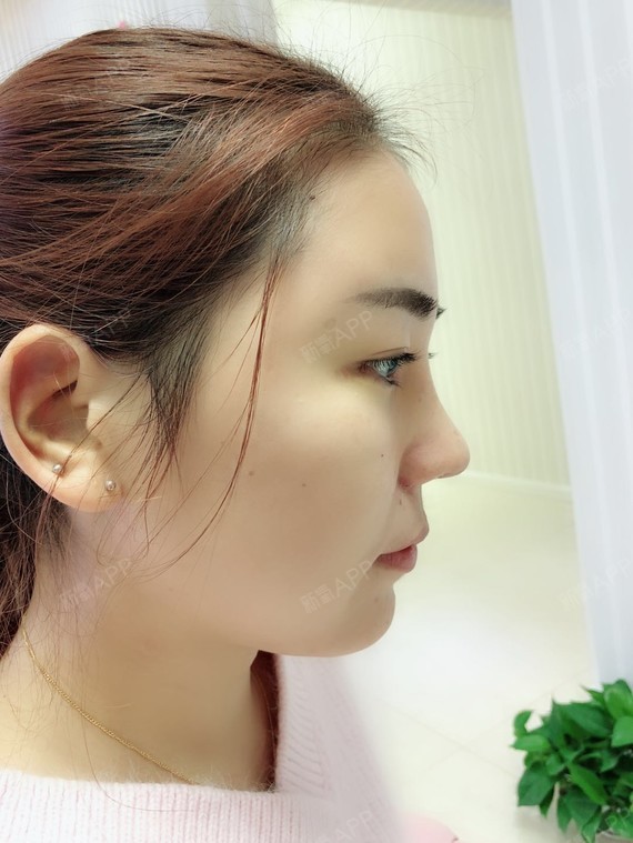 膨体隆鼻好不好_效果图_kawaii仙女膨体隆鼻术后第8天_新氧美容整形