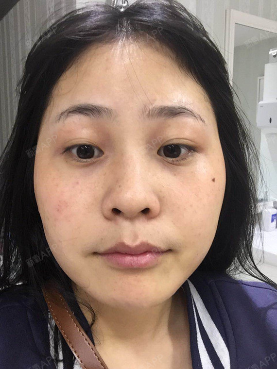 光纤溶脂瘦脸好不好_效果图_不值得爱过你光纤溶脂瘦脸术后第23天