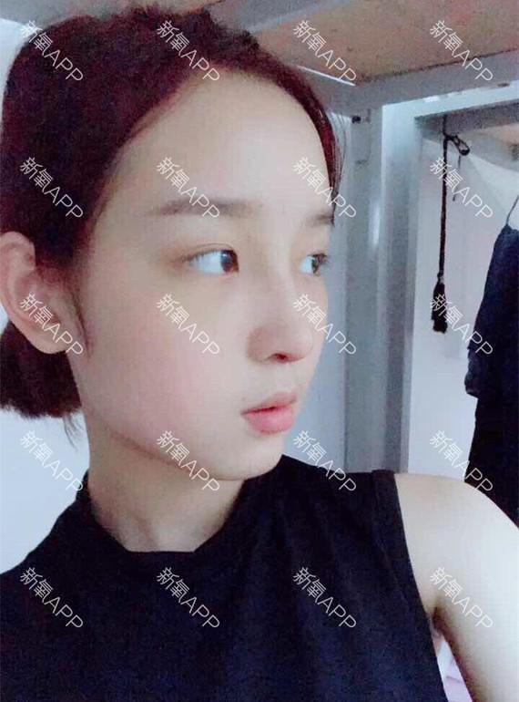 瀋陽美萊醫療美容醫院鼻綜合怎麼樣_恢復過程_效果如何_李紅紅整形