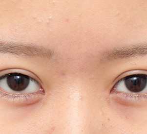 缔妍医疗美容下眼下至术怎么样?