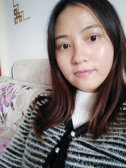 【苏州美莱双眼皮术后第10天】做完双眼皮已经有十天_圈子-新氧美容