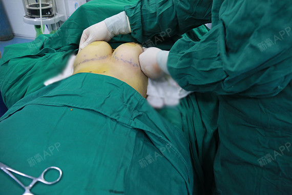 新氧- 氧气7364346310123 | 假体隆胸 | 术后当自强 | 深圳同城