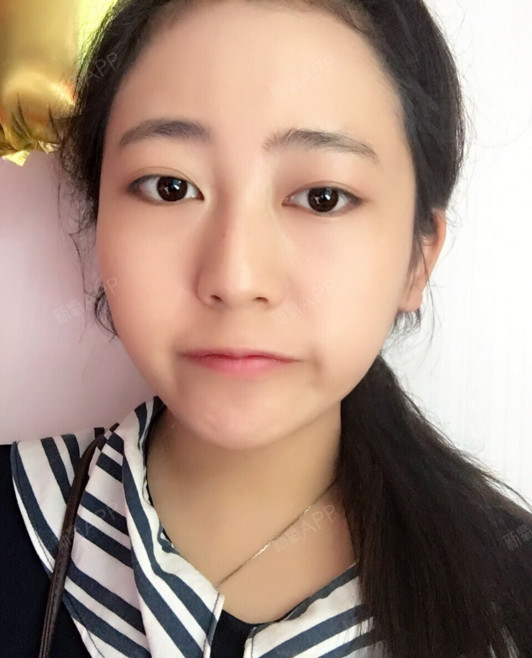 常州上眼睑去脂好不好_效果图_氧气tgp5d89上眼睑去脂术后第98天_新氧