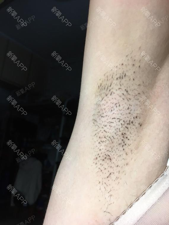 部分腋毛长出来了,但是数量比起没做脱毛之前明显减少_圈子-新氧美容
